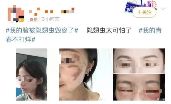 隱翅蟲的毒液堪比硫酸！專家提醒：見到千萬別拍(圖2)